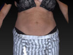 CoolSculpting