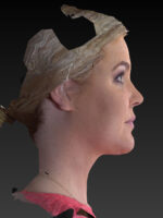 Facelift