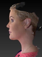 Facelift