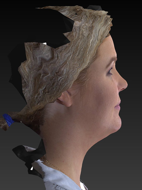 Facelift