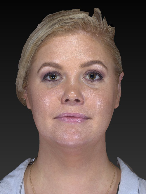 Facelift