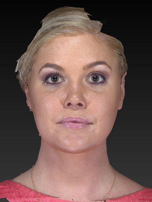 Facelift