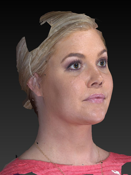 Facelift