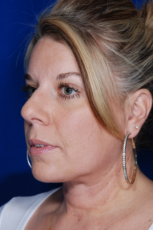 Facelift