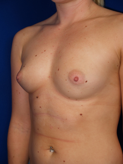 Breast Augmentation