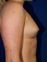 Breast Augmentation