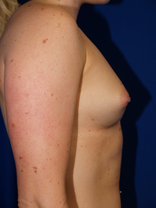 Breast Augmentation