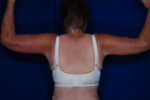 Brachioplasty