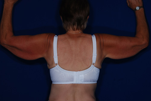 Brachioplasty