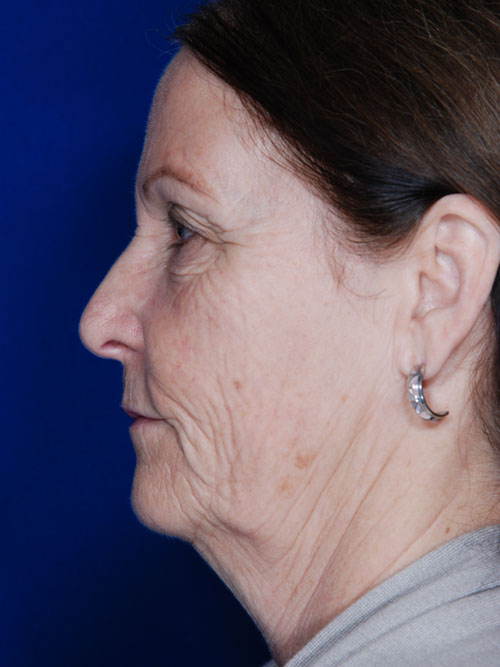 Facelift