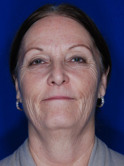 Facelift
