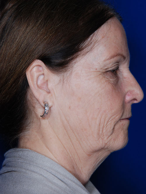 Facelift