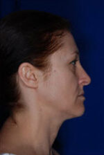 Face Fat Transfer