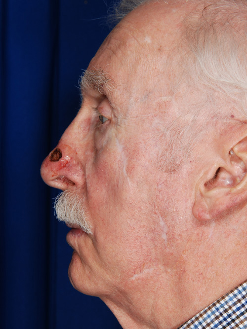 Skin Cancer Reconstruction