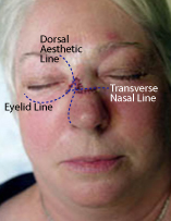 Skin Cancer Reconstruction
