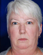 Skin Cancer Reconstruction