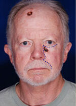 Skin Cancer Reconstruction