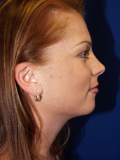 Chin Implant