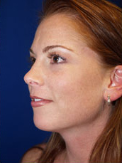 Chin Implant