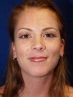 Chin Implant