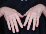 Hand Rejuvenation