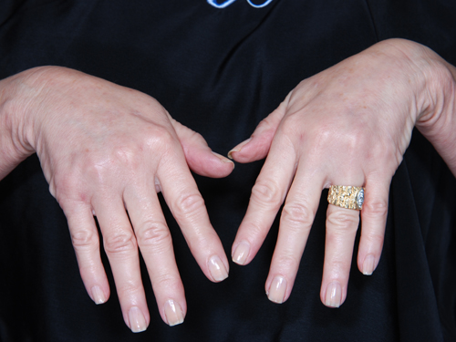 Hand Rejuvenation