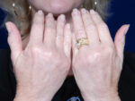 Hand Rejuvenation