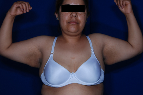 Brachioplasty