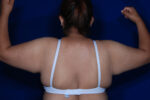 Brachioplasty