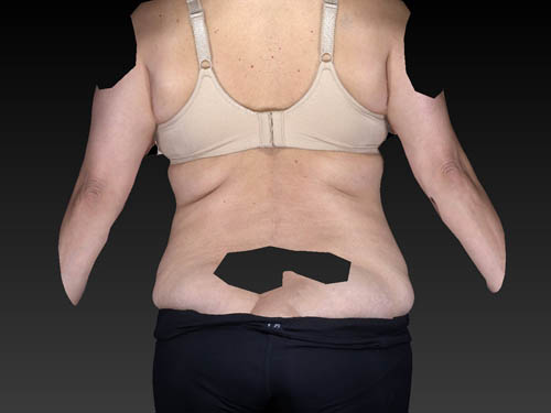 CoolSculpting