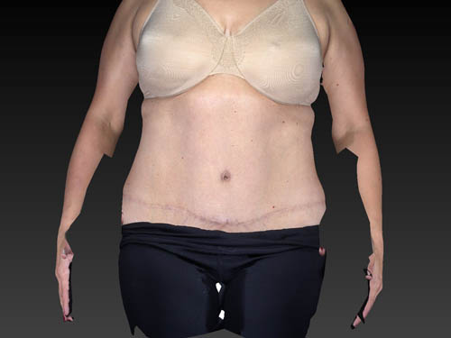 CoolSculpting