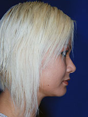 Chin Implant