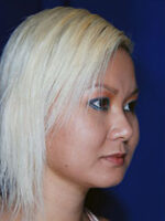 Chin Implant