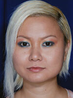 Chin Implant