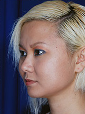 Chin Implant