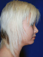Chin Implant