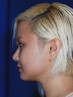 Chin Implant