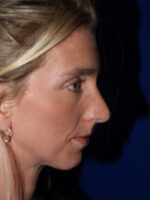 Chin Implant