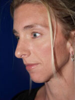 Chin Implant