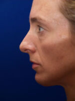 Chin Implant