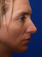 Chin Implant