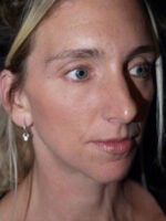Chin Implant