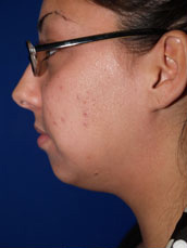 Chin Implant
