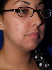 Chin Implant