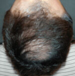 Light Therapy For Hair Growth