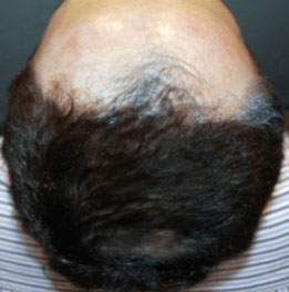 Light Therapy For Hair Growth