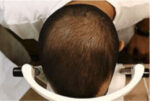 Hair Re-Growth