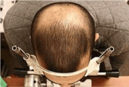 Hair Re-Growth