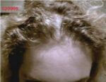 Hair Re-Growth