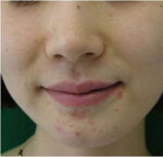 Secret Fraxis RF MicroNeedling
